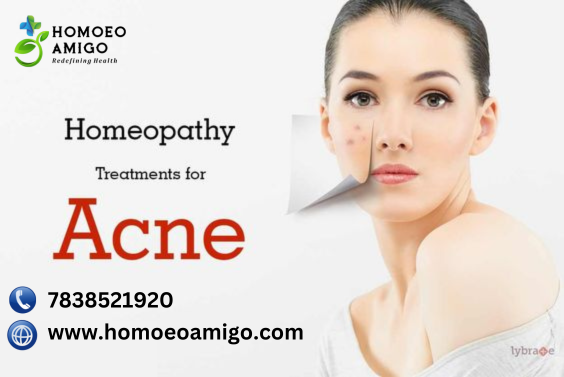 Best Acne Homeopathic Treatment In Delhi | Top Homeopathic Doctors And Clinics